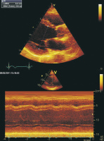 Abbildung 2: Parasternaler Längsschnitt - M-Mode