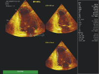 Abbildung 6: Linksventrikuläre Volumina - EF