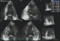 Abbildung 7: Linksventrikuläre Volumina -  EF