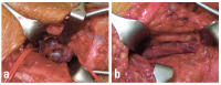 Abbildung 4a-b: Intraoperativer Befund