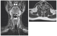 Abbildung 6: Kontrolle 3 Monate nach Sklerosierung