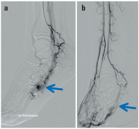 Abbildung 7a-b: Angiographisches Bild