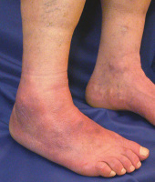 Abbildung 2: Acrodermatitis chronica atrophicans