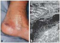 Abbildung 3a-b: Sichelhämatom