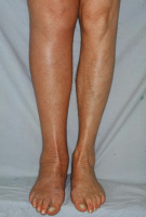 Abbildung 4: Beinvenenthrombose