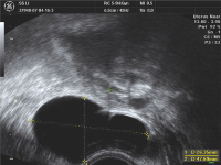 Abbildung 1: große, linksseitige Sactosalpinx