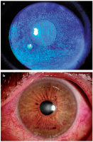 Abbildung 1a-b: Schädigung Auge
