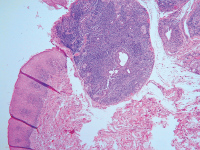 Abbildung 3: histologisches Bild Sjögren Syndrom