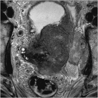 Abbildung 1: mehrmaliger TUR-P