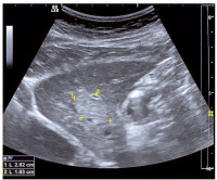 Abbildung 1: Rundherd der Leber