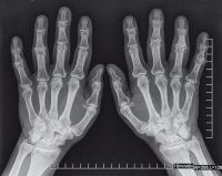 Abbildung 1: Arthrose