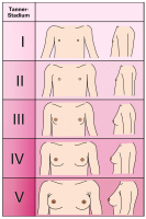 Abbildung 2: Tanner-Stadien