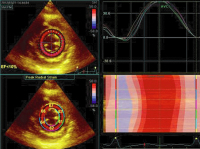 Abbildung 10: Speckletracking