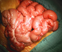 Abbildung 2: Debulking-Operation