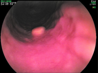 Abbildung 2: Tumor - Ösophagus