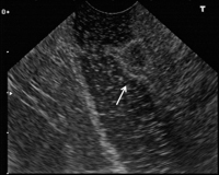 Abbildung 4: Gastrinom - Duodenum
