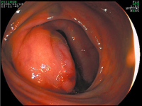 Abbildung 5: Tumor - Ileum