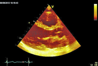 Abbildung 1: Parasternaler Längsschnitt