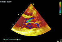 Abbildung 2: Parasternaler Längsschnitt