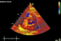 Abbildung 3: Parasternaler Querschnitt