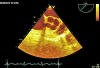 Abbildung 5: Transösophageales Echo