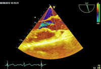 Abbildung 6: Transösophageales Echo