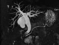 Abbildung 3: Choledocholithiasis