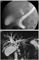 Abbildung 4a-b: Cholangitis