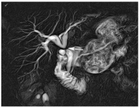 Abbildung 5: Cholecystektomie - Choledochusrevision
