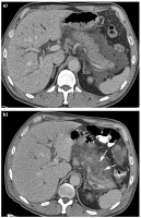 Abbildung 7a-b: Akute Pankreatitis
