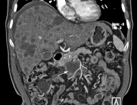 Abbildung 9: Pankreas - Adenokarzinom
