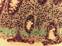 Abbildung 2: Kollagene Kolitis