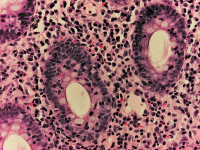 Abbildung 3: Lymphozytäre Kolitis