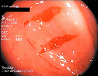 Abbildung 4: Kollagene Kolitis