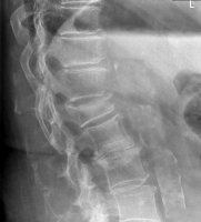 Abbildung 1: Sinterungsfraktur