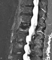 Abbildung 2: Deckplattenimpressionsfraktur