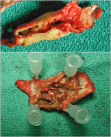 Abbildung 1: Karotisplaques