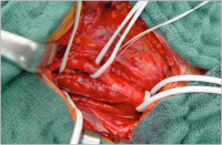 Abbildung 2: Patchplastik