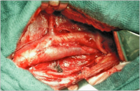 Abbildung 3: Eversionsendarteriektomie