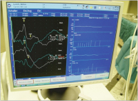 Abbildung 4: Hirnmonitoring