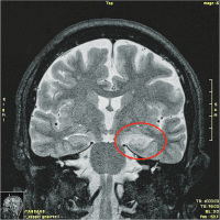 Abbildung 1: Limbische Enzephalitis