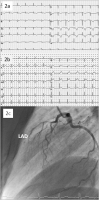 Abbildung 2a-c: STEMI