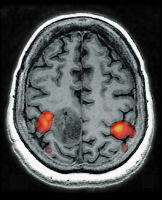 Figure 1: Brain tumour 