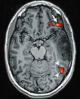 Figure 2: Brain tumour