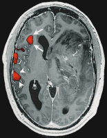 Figure 3: Brain tumour