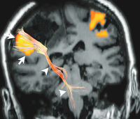 Figure 4: Brain tumour