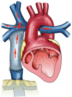 Abbildung 2: Fontan-Operation