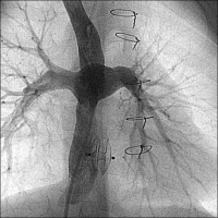 Abbildung 3: Tunnelfenestration