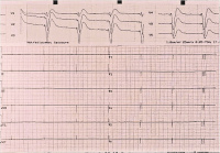 Abbildung 1: Letales EKG