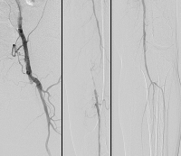 Abbildung 1: Angiogramm
